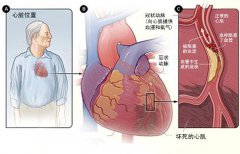 冠心病的起因是什么？