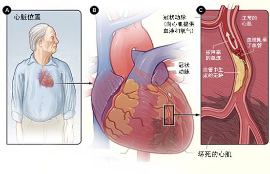 怎樣治療冠心??？(圖3)