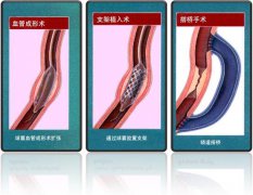 怎樣治療冠心??？
