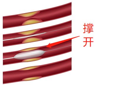 什么是藥物球囊？(圖2)
